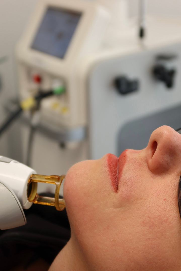 Séance d'épilation laser du visage