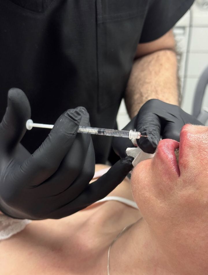 Injection d'acide hyaluronique au niveau des lèvres