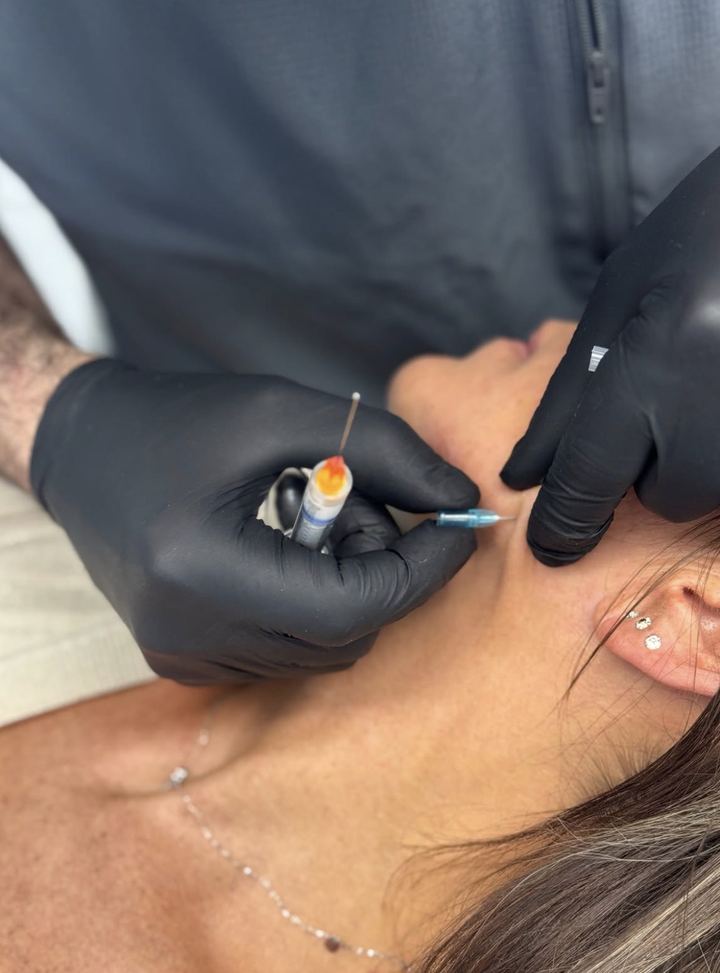 Injection d'acide hyaluronique au niveau de l'ovale du visage