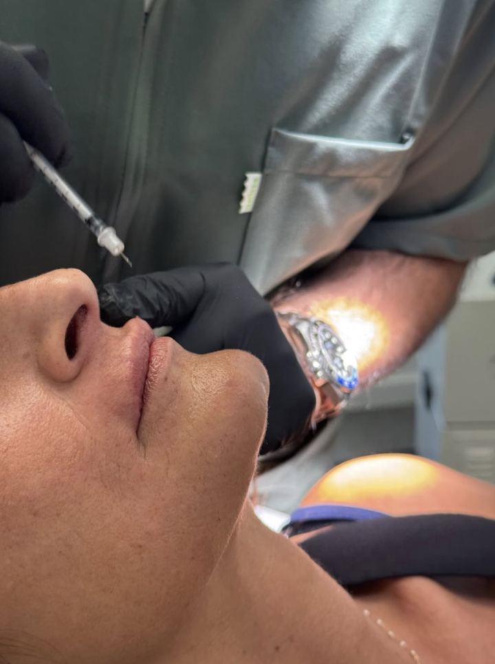 Injection au niveau de la lèvre supérieure