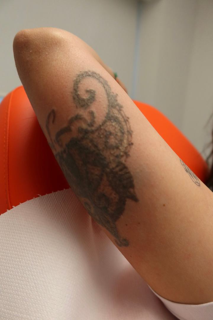 Tatouage du bras avant une séance de détatouage laser