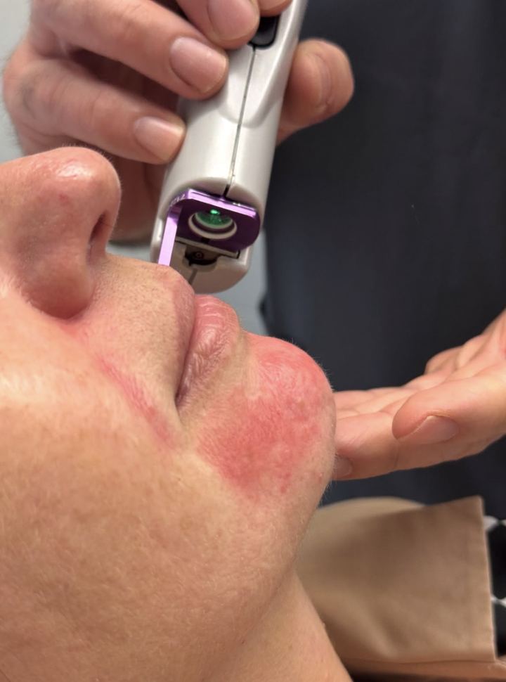 Séance de laser vasculaire Candela Vbeam autour de la bouche