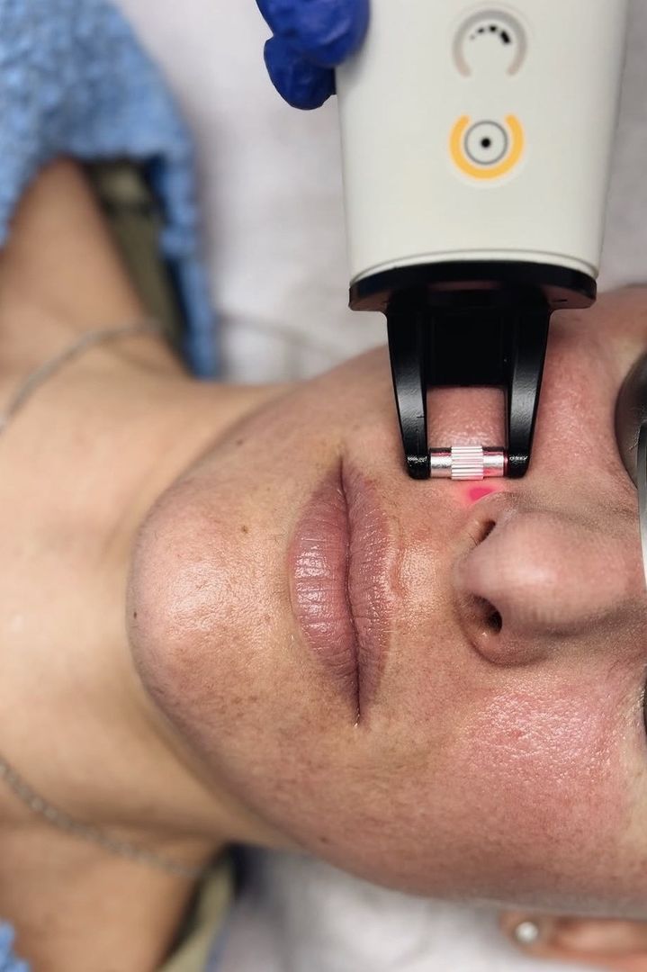 Séance de laser fractionné non ablatif sur le visage (Candela Frax Pro)