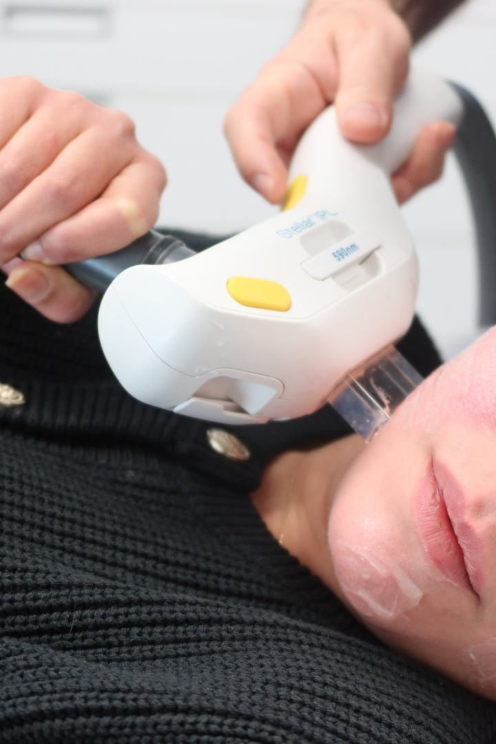 Pièce à main Lumenis Stellar IPL (590 nm) sur le visage