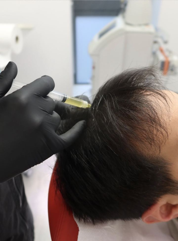 Injection de PRP dans le cuir chevelu