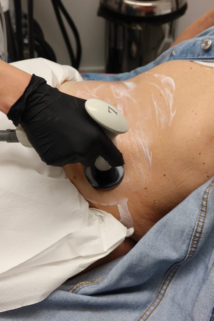 Séance de radiofréquence NuEra sur l'abdomen