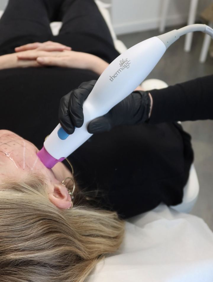 Séance de Thermage FLX sur le visage