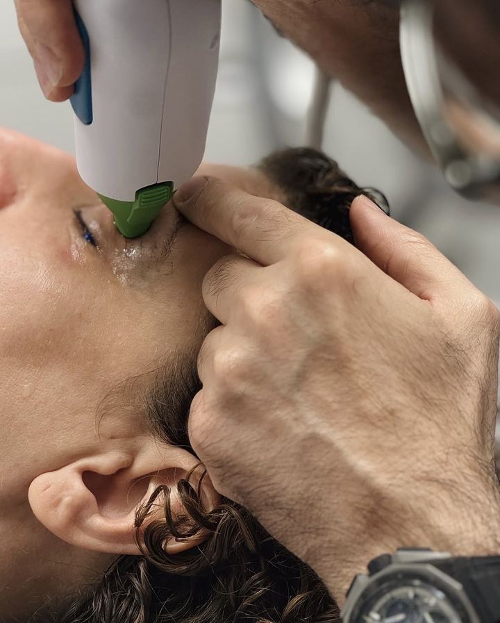 Séance de Thermage FLX sur le contour des yeux